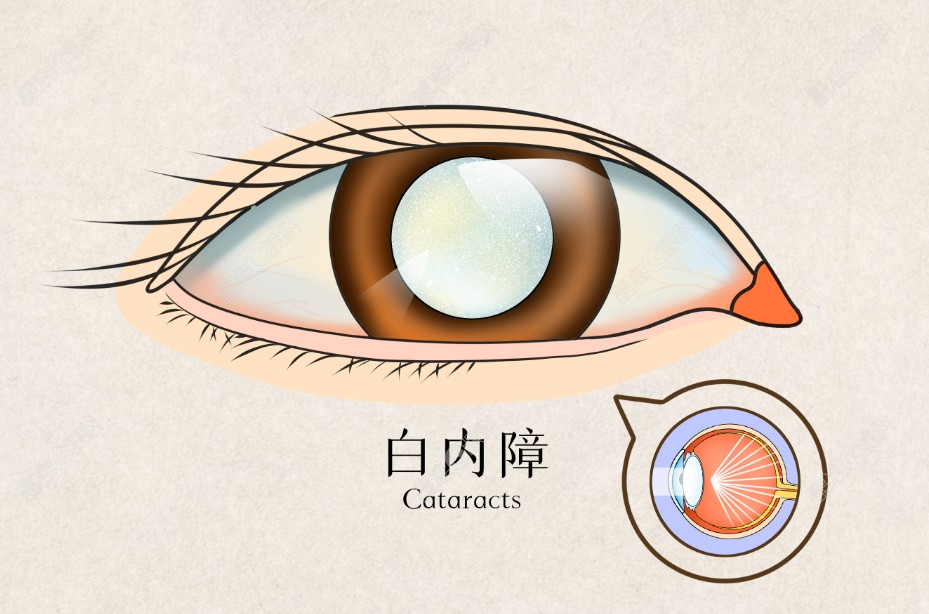 白内障人工晶体有度数吗www.ji-zhun.com