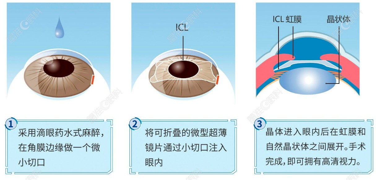 江门五邑爱尔新希望眼科医院赵春阳医生怎么样