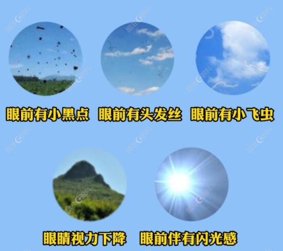 飞蚊症是什么