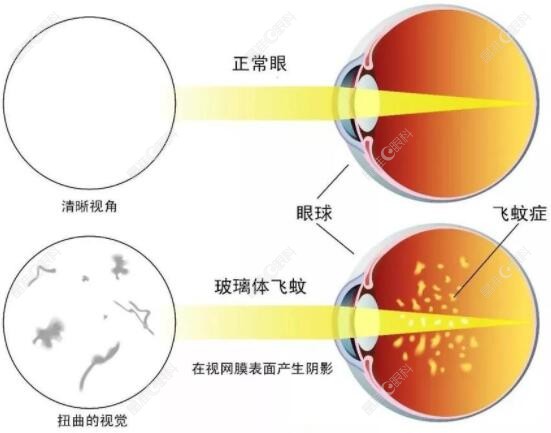 做了近视手术会得飞蚊症吗