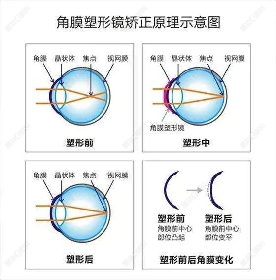 角膜塑形镜矫正视力的原理