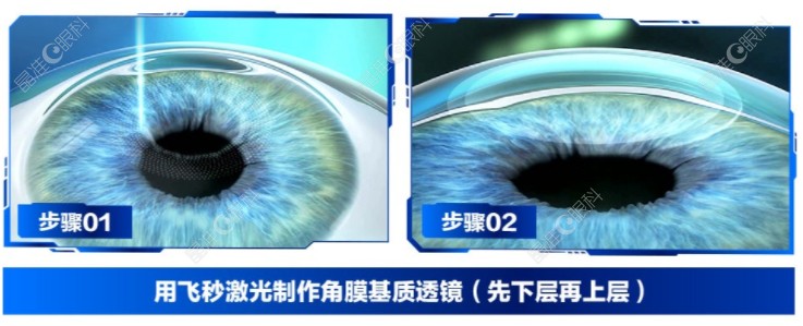 近视眼激光手术大约多少钱