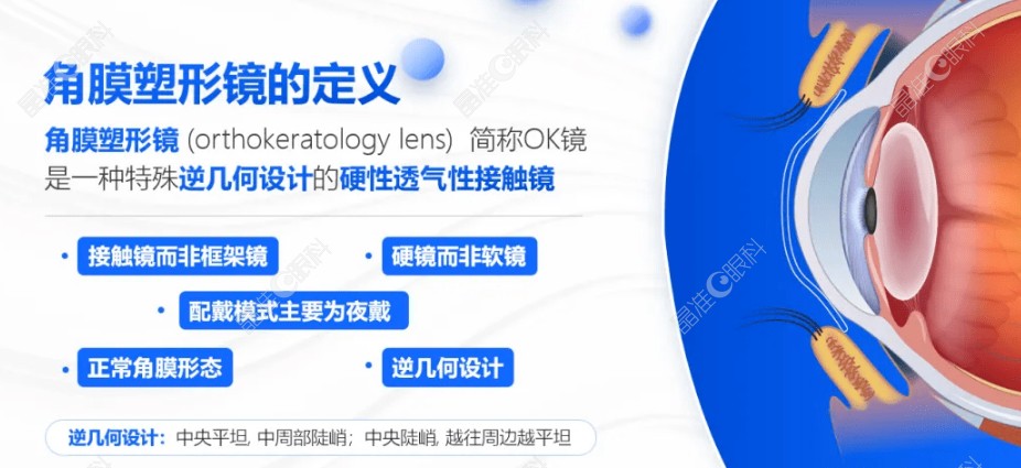 600度近视能戴角膜塑形镜防控近视