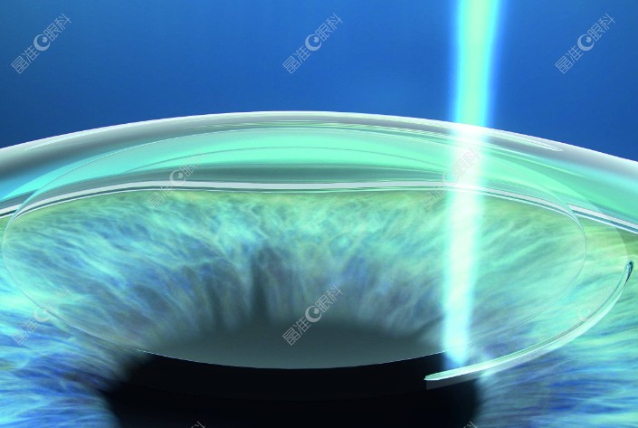 长沙睛点眼科全飞秒手术好