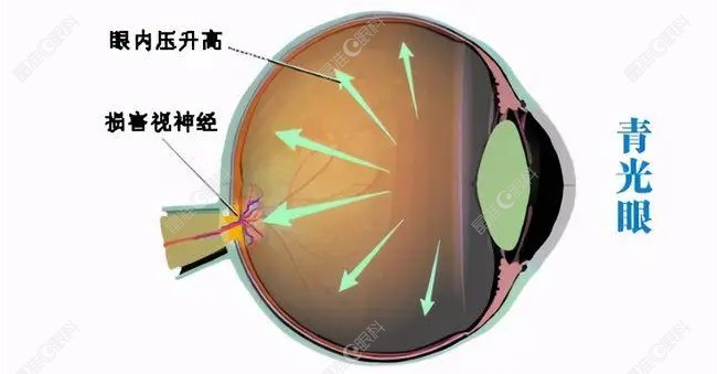 青光眼激光手术优缺点