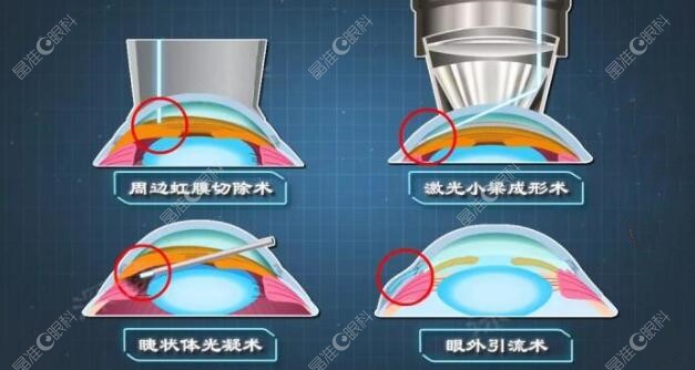 青光眼激光手术价格是多少www.ji-zhun.com