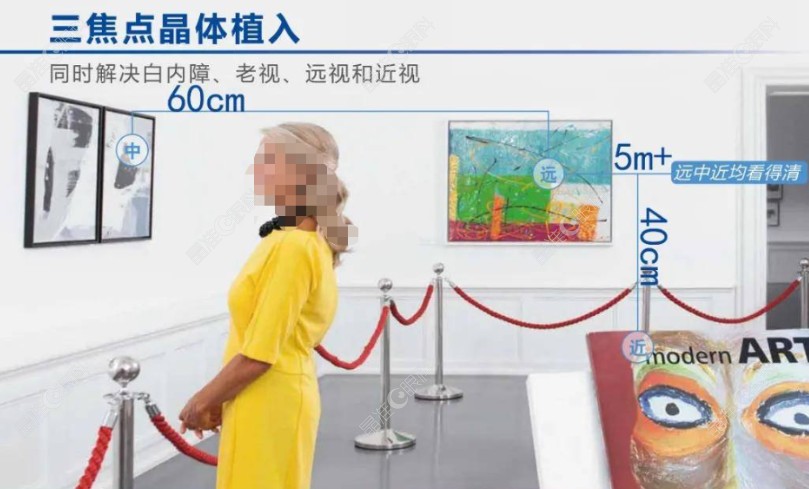 三焦晶体植入多长时间达到较好视力