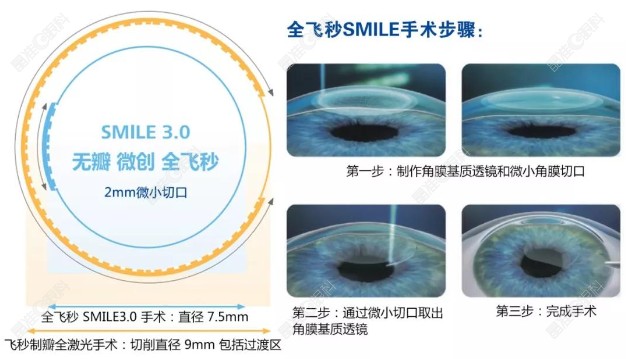 景德镇爱尔眼科医院全飞秒手术