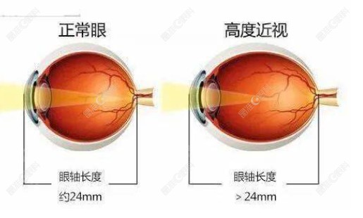 高度近视做后巩膜加固术可改善视力