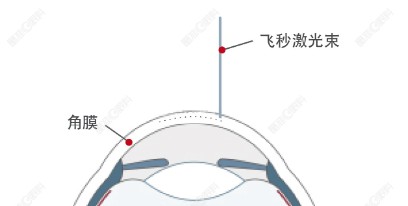 全飞秒手术使用飞秒激光