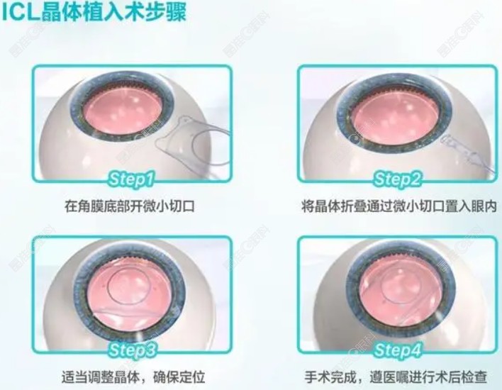 刘保松医生做icl晶体植入手术好吗