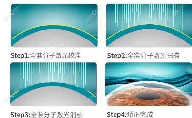 准分子激光手术过程