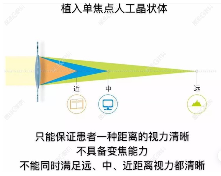 爱尔康人工晶体3700元是单焦点人工晶体