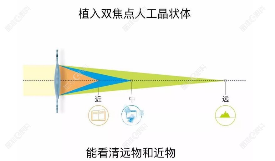 双焦点晶体植入手术优势