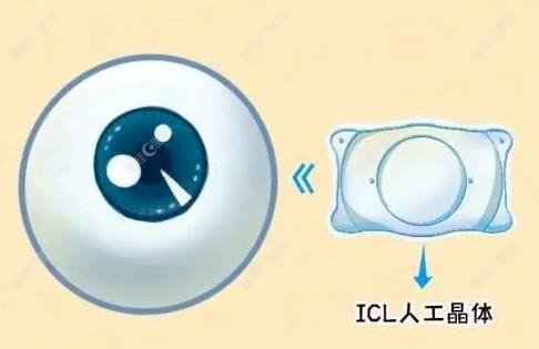 济南明水眼科icl晶体植入手术价格