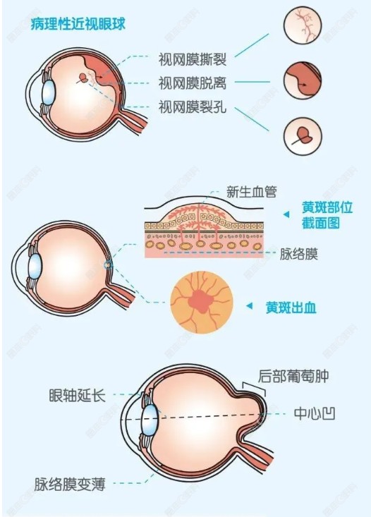 高度近视视网膜病变治疗方案