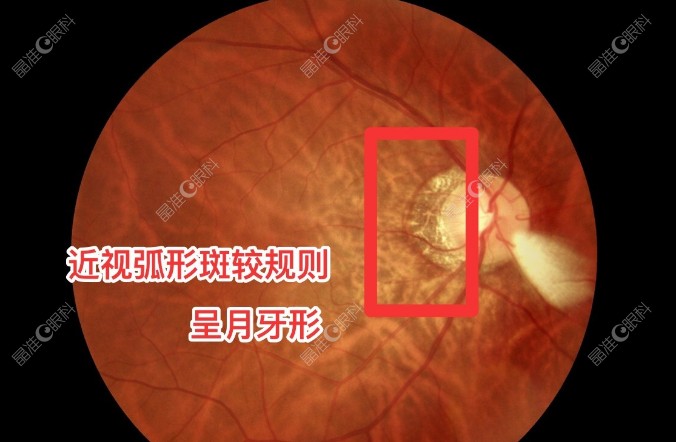 高度近视视网膜病变怎么治疗