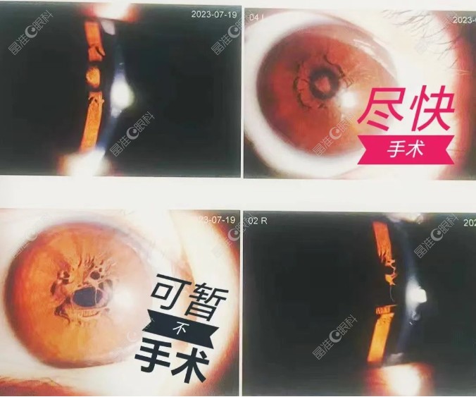 先天性瞳孔残膜疾病的类型