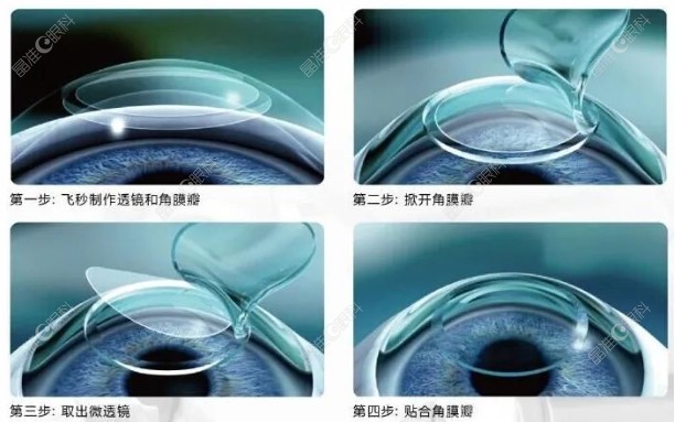 全飞秒手术过程图解