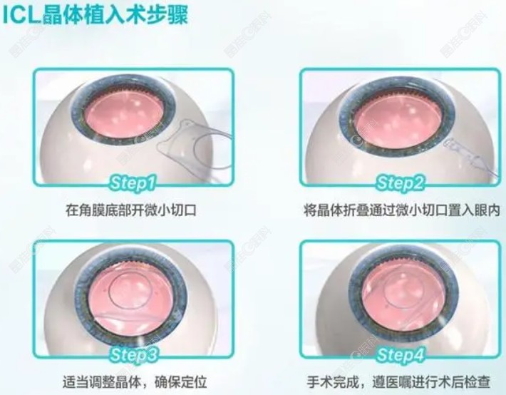 icl晶体植入近视手术步骤 晶准眼科