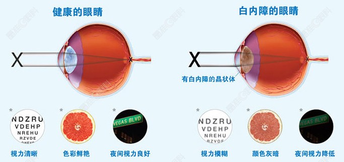 icl晶体植入后有白内障要换晶体吗