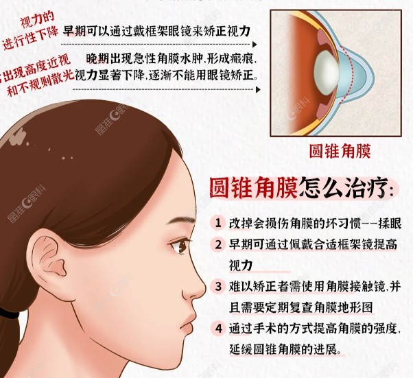 圆锥角膜治疗办法m.ji-zhun.com