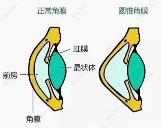 圆锥角膜是什么晶准眼科