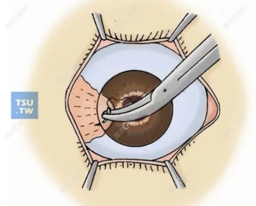 角膜移植手术