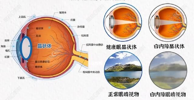 预约刘保松做白内障晶体植入手术