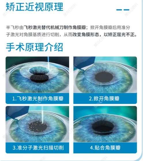 飞秒手术十年后真实感受