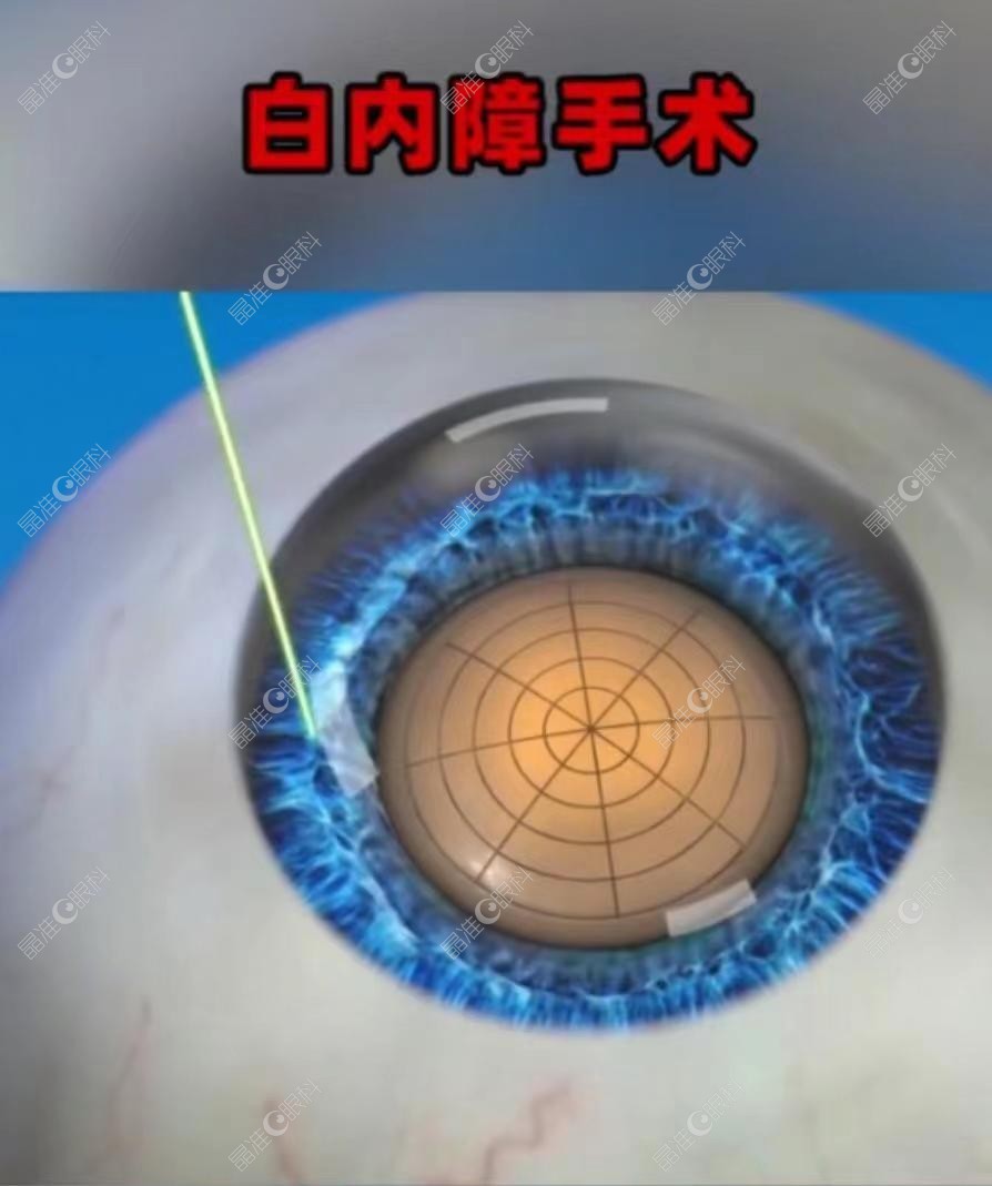 明水眼科医院郑秀华做白内障手术怎么样