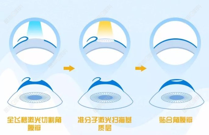 半飞秒近视手术过程和步骤