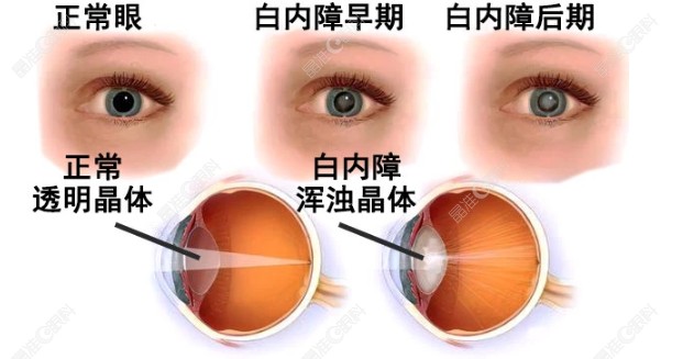 双眼白内障单个做手术疗效好