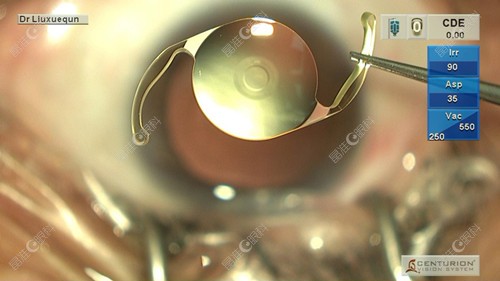 Vivity IOL晶体www.ji-zhun.com