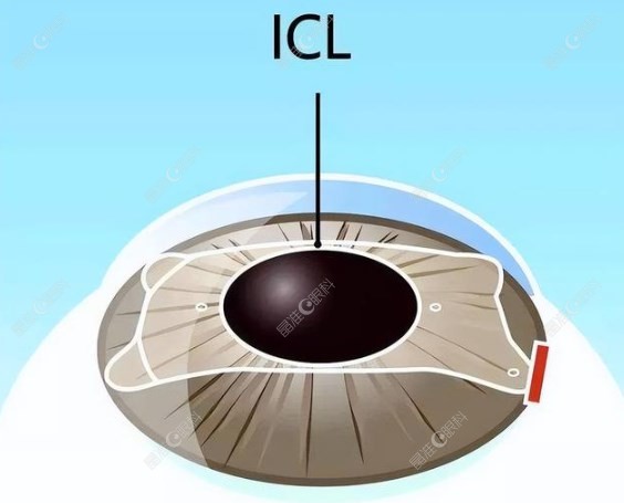 icl拱高过低是尺寸过大吗