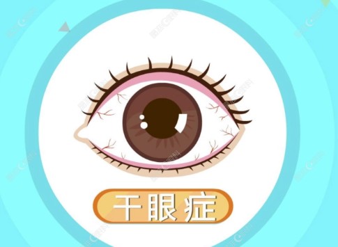 近视手术后干眼症多久能好？www.ji-zhun.com