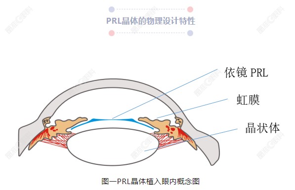 1500度可以做prl晶体植入近视手术