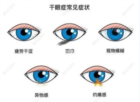 全飞秒术后干眼症多久恢复？