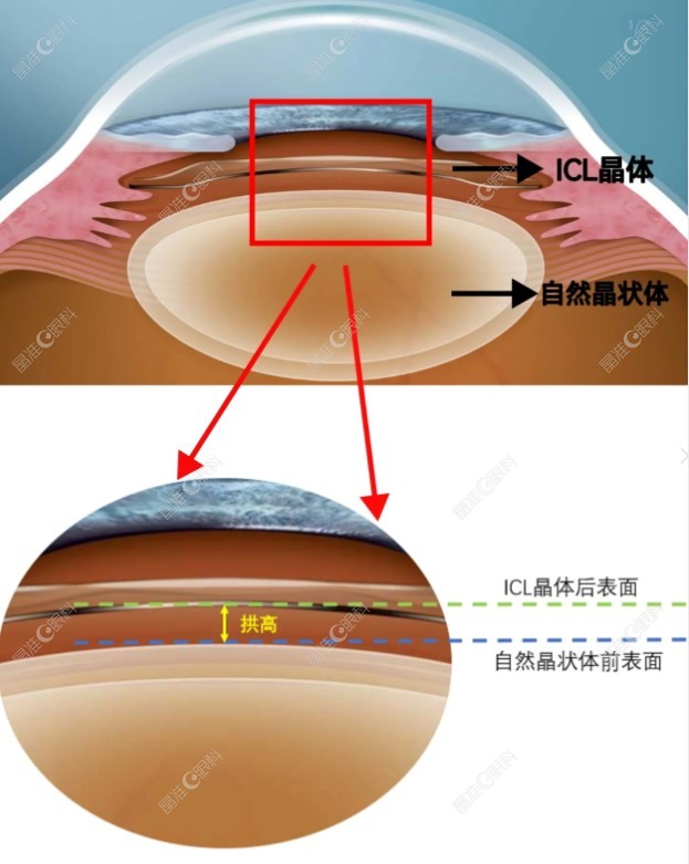 icl拱高必然逐年下降吗ji-z/hun.com