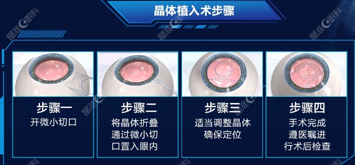 1500度近视可以做icl晶体植入近视手术