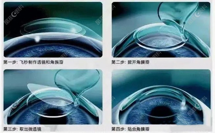 院内做白内障治疗的手术原理