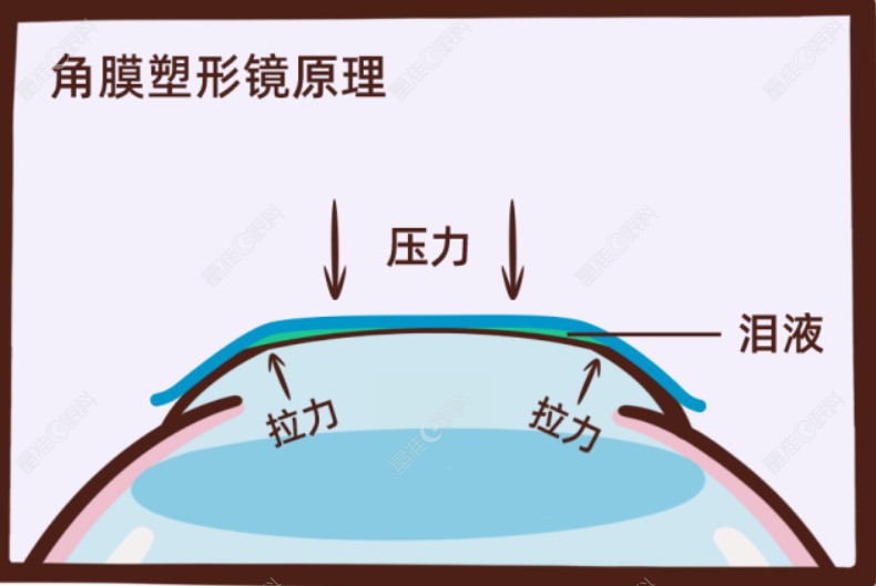 爱尔眼科配眼镜4000多划算吗