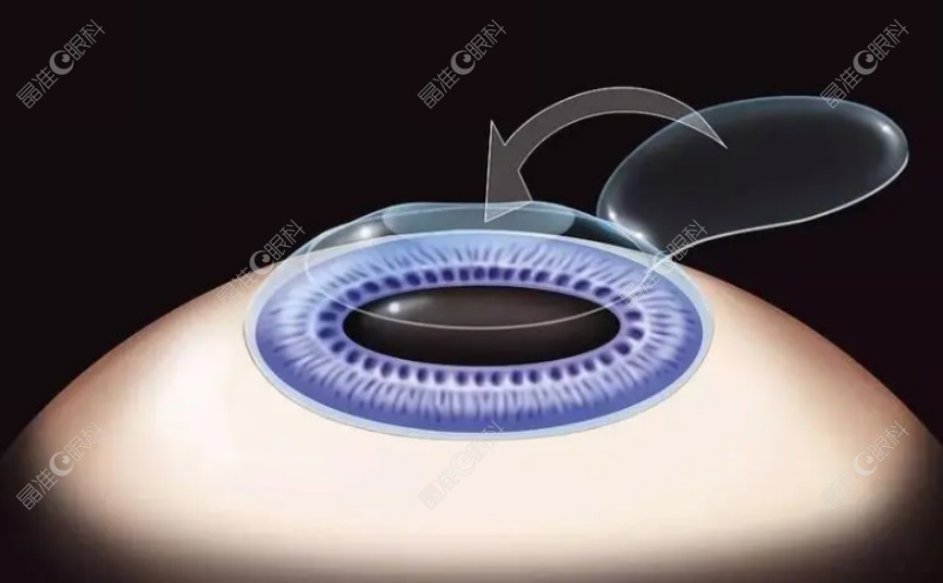 北京爱尔眼科近视手术