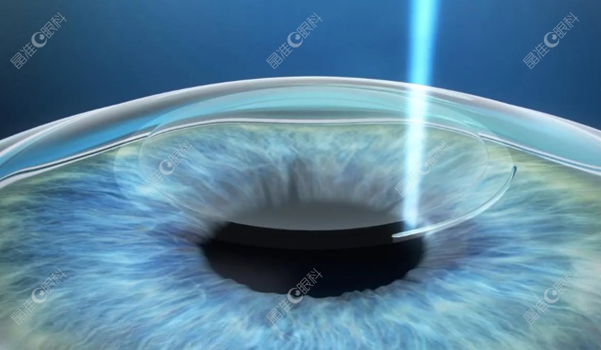 北京爱尔眼科近视手术