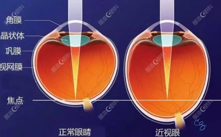 近视手术