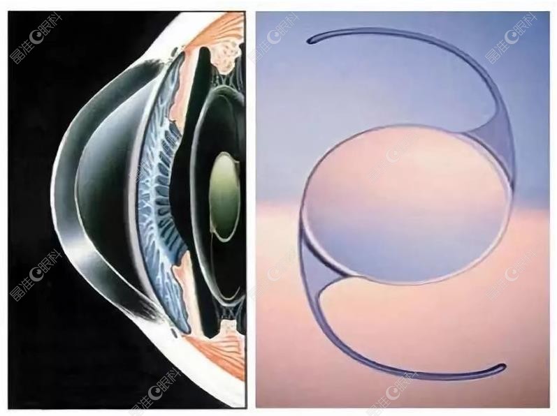 非球面人工晶体的缺点