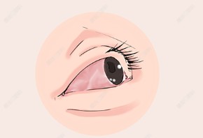 角膜炎