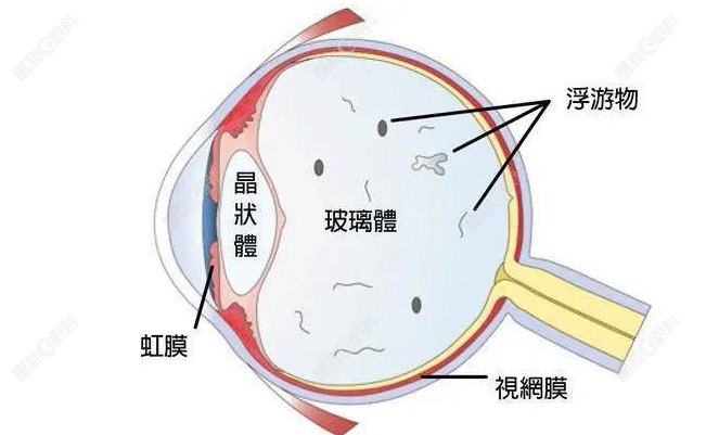 王乐今后巩膜加固术怎么样