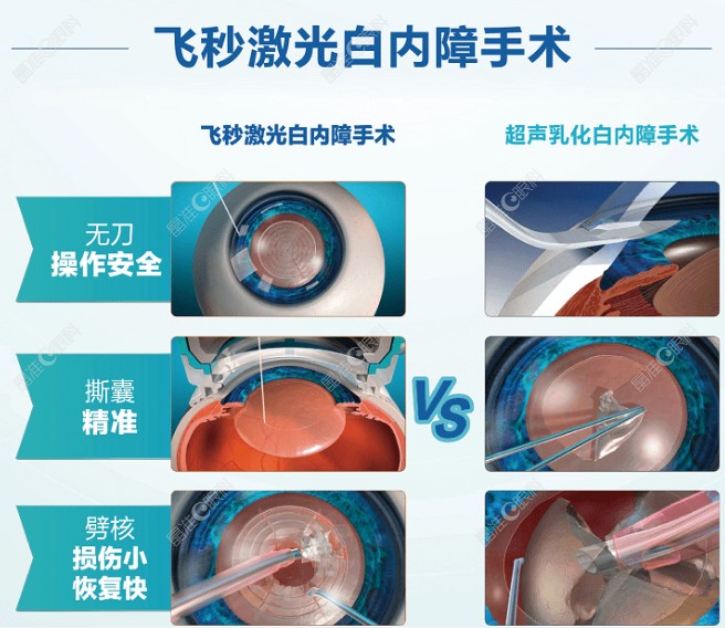 飞秒激光白内障手术和传统超声乳化白内障手术区别图片