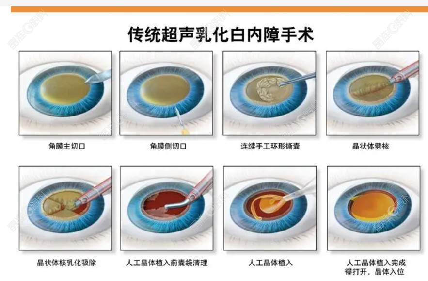 佛山爱尔眼科医院白内障手术过程和步骤
